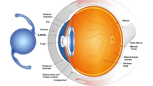 multifocal intraocular lenses