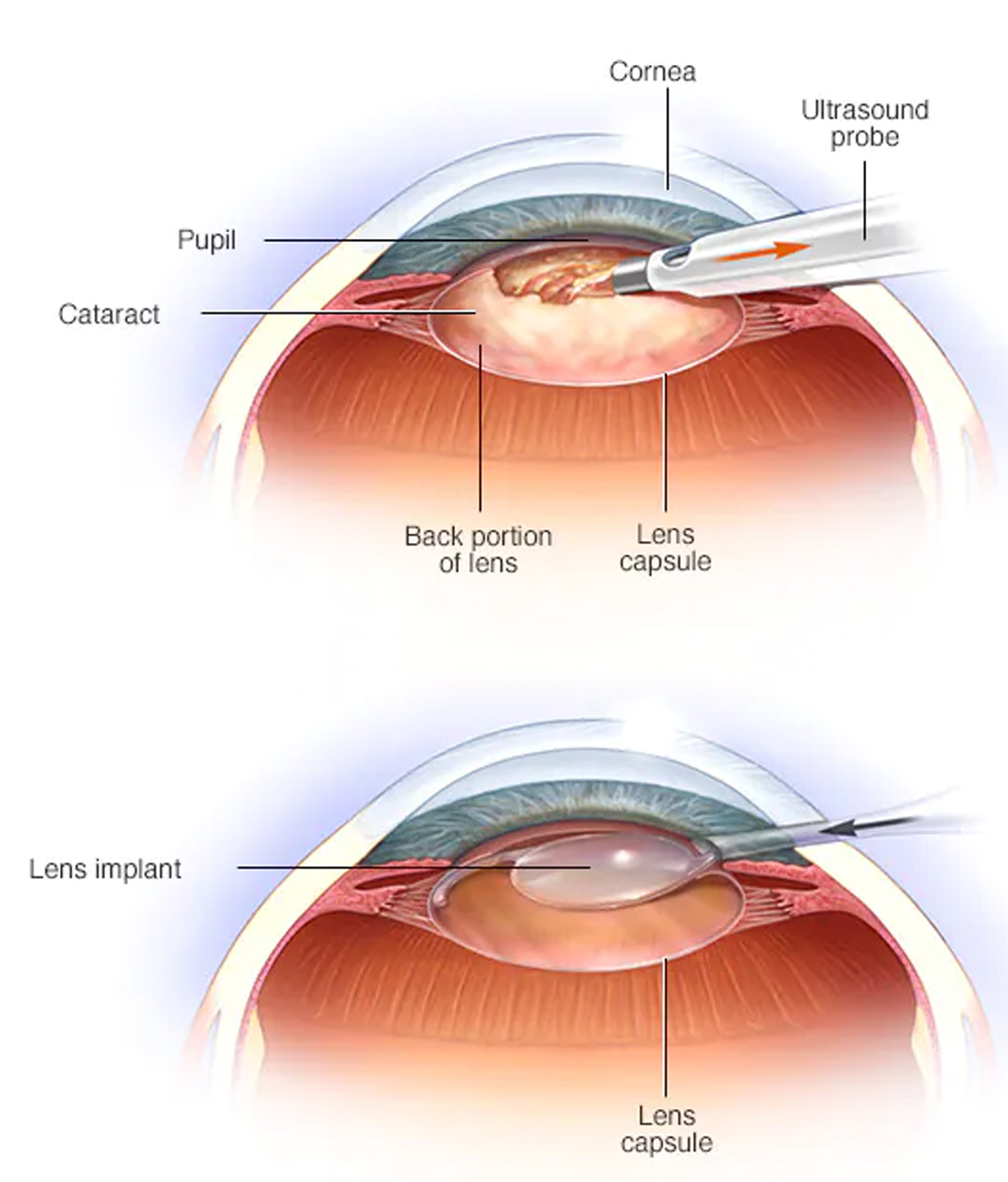 Cataract Surgery in Mumbai