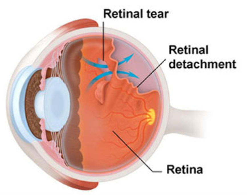 Retina specialist in Ghatkopar